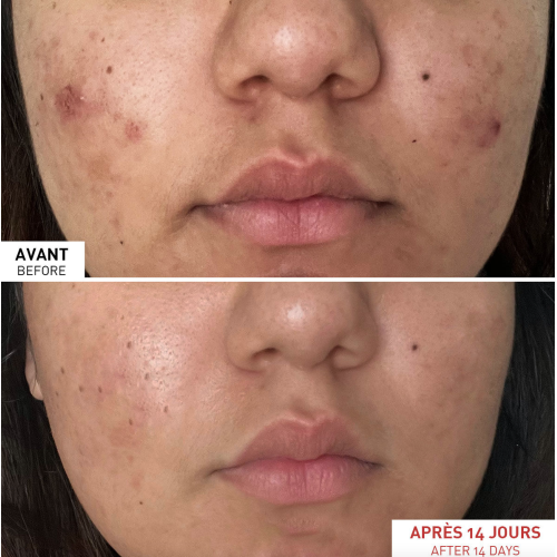 Centella Acne Care Soin acné et anti-imperfections 30 ml