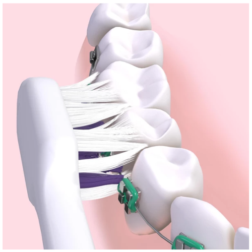 Sonic Ortho Brossette de Rechange Pour Brosse à Dents Sonic Souple 2 Brossettes