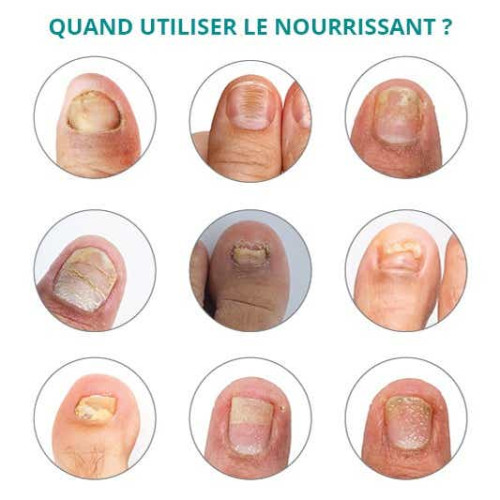 PODERM Huile-Sérum Nourrissante 8ml - Soin Ongles Secs et Cassants