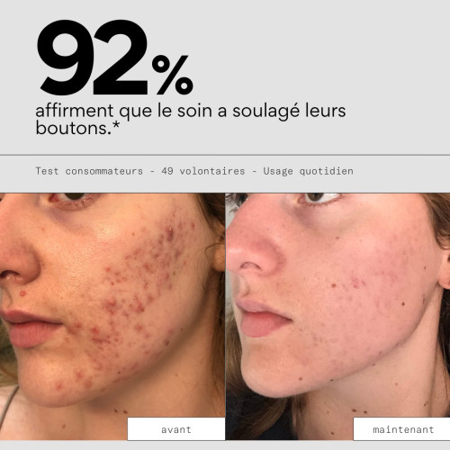 Soin Stop Boutons SKIN&OUT : Anti-inflammatoire et maturant