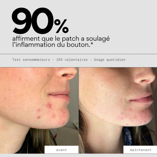 Patch XL Boutons Skin&Out : Cicatrise & Élimine les Boutons Rapidement