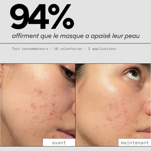 Masque SOS Boutons Skin&Out : Apaisement naturel contre l'acné