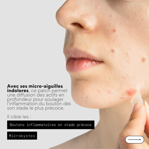 Skin&Out Patchs Stop Boutons : Solution anti-boutons sous-cutanés