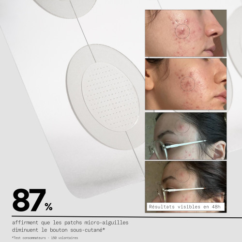 Skin&Out Patchs Stop Boutons : Solution anti-boutons sous-cutanés