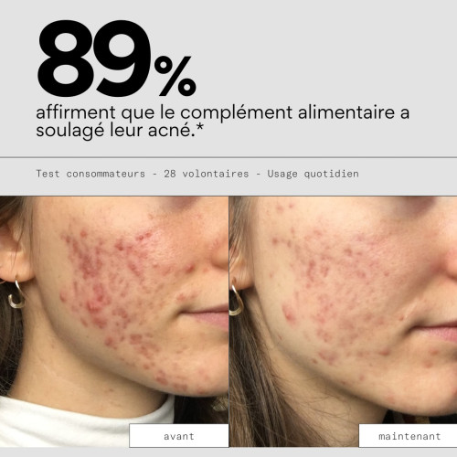 STOP BOUTON SKIN&OUT : Contrôlez l'acné adulte naturellement