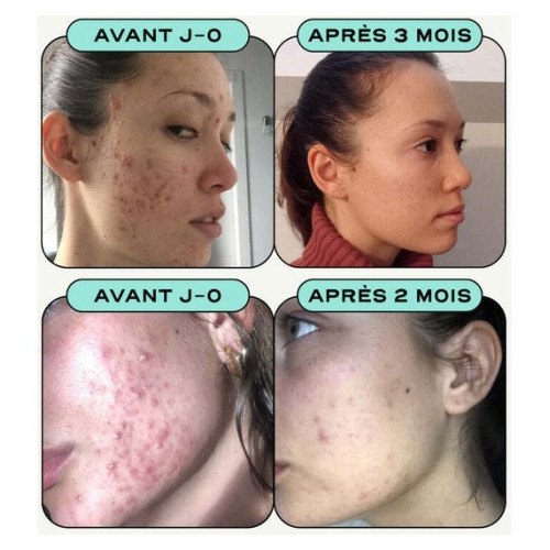 Circles CLEAR - Gélules Détox Peau Nette | Acné Hormonale